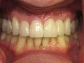 After implant dentistry treatment