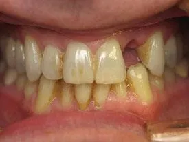 Before implant dentistry treatment