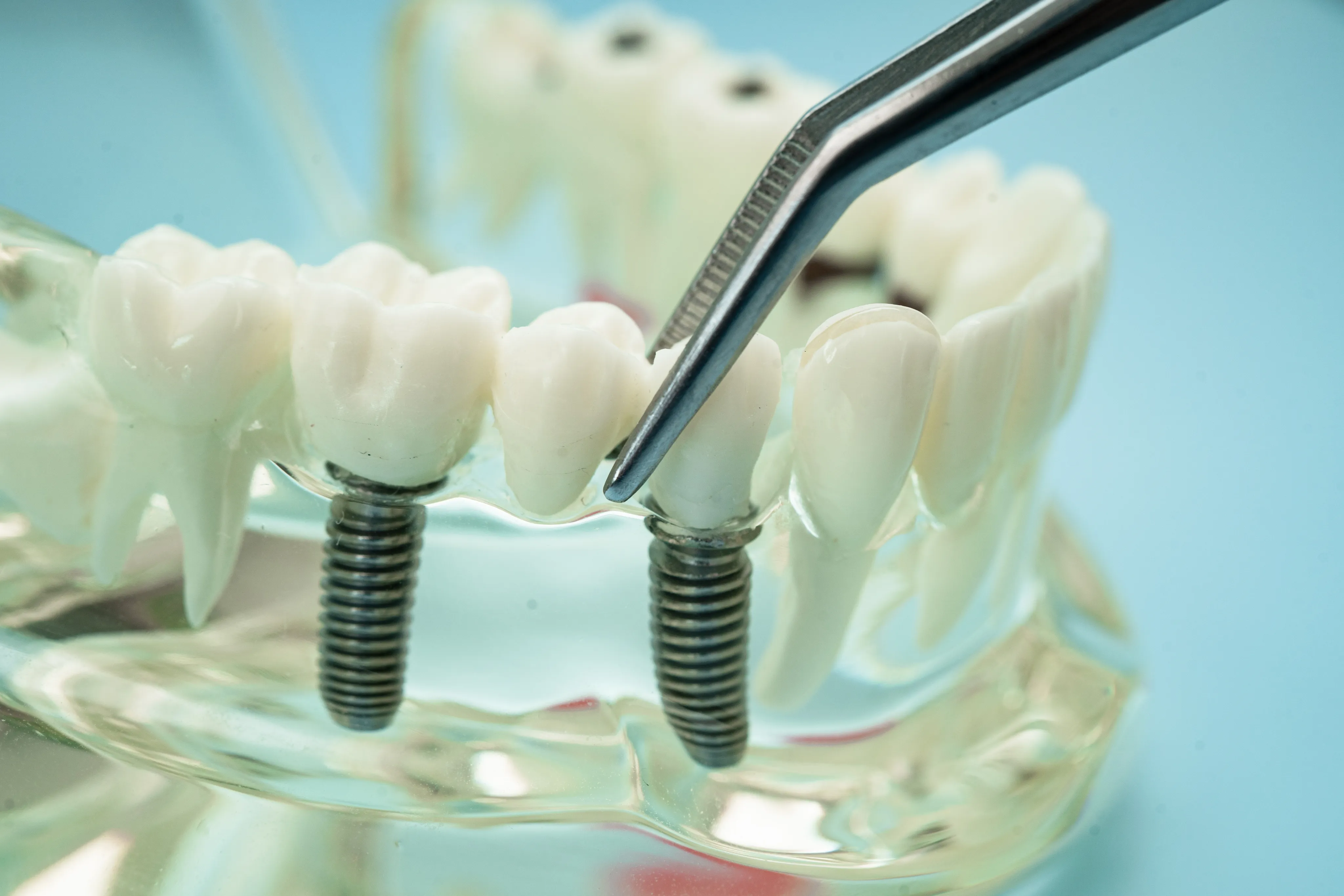 Dental implant model showing abutment and crown placement