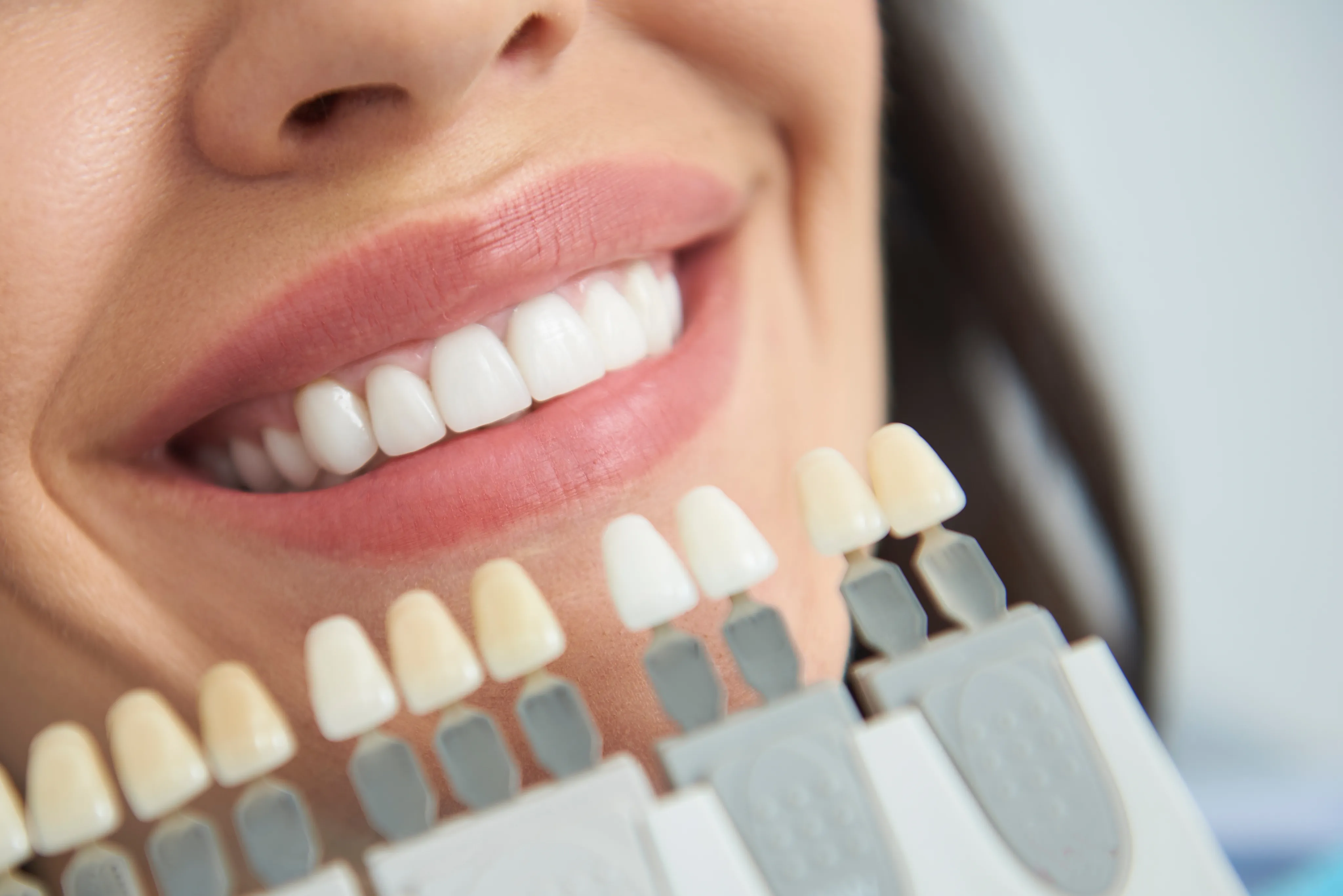 Smile with porcelain veneer shade guide comparison